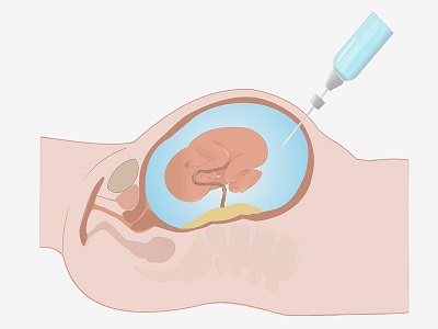 First Trimester Screening for Down’s Syndrome